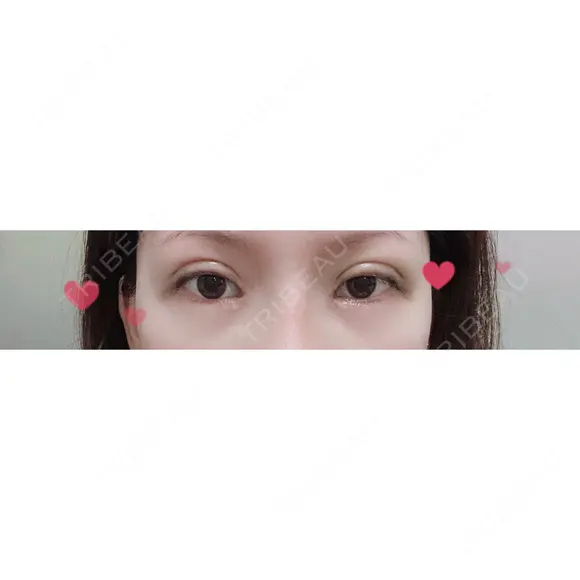 二重切開 / 目頭切開 / 上まぶたの脂肪取り / 蒙古ひだ形成 FROM B整形外科 (旧バウム整形外科) DAY 9 メイン用