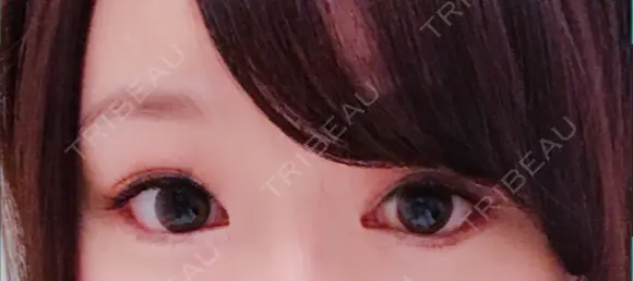 目尻切開 / タレ目形成・グラマラスライン（切開） シエルクリニック DAY 18 メイン用