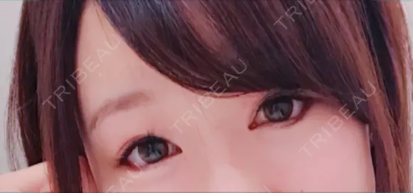 目尻切開 / タレ目形成・グラマラスライン（切開） シエルクリニック DAY 18 メイン用