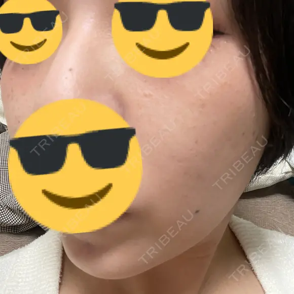 ルメッカ / インモード NYAN CLINIC DAY 6 メイン用