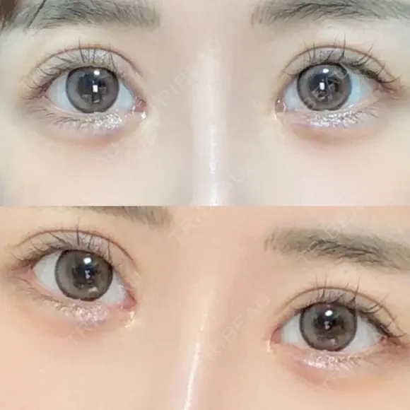 ヒアルロン酸注入（涙袋） HAAB×DREAM BEAUTY CLINIC 東京本院 DAY 9 メイン用
