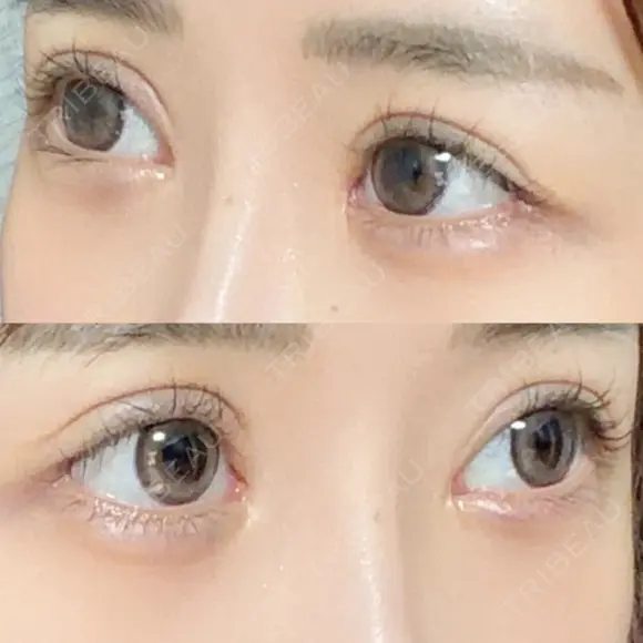 ヒアルロン酸注入（涙袋） HAAB×DREAM BEAUTY CLINIC 東京本院 DAY 9 メイン用
