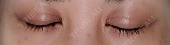 二重埋没 NARU Beauty Clinic 【ナルクリ】 DAY 28 メイン用