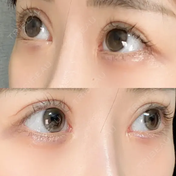 ヒアルロン酸注入（涙袋） HAAB×DREAM BEAUTY CLINIC 東京本院 DAY 14 メイン用
