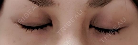 二重埋没 NARU Beauty Clinic 【ナルクリ】 DAY 30 メイン用