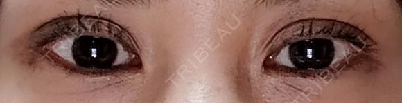 二重埋没 NARU Beauty Clinic 【ナルクリ】 DAY 30 メイン用