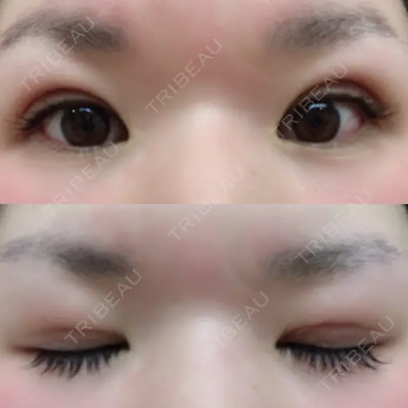 二重埋没 メディカルビューティセンター DAY 7 メイン用