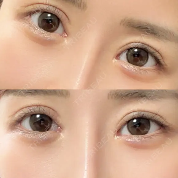 ヒアルロン酸注入（涙袋） HAAB×DREAM BEAUTY CLINIC 東京本院 DAY 29 メイン用