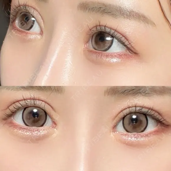 ヒアルロン酸注入（涙袋） HAAB×DREAM BEAUTY CLINIC 東京本院 AFTER メイン用