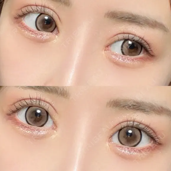 ヒアルロン酸注入（涙袋） HAAB×DREAM BEAUTY CLINIC 東京本院 DAY 30 メイン用