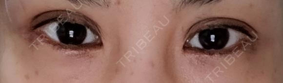 二重埋没 NARU Beauty Clinic 【ナルクリ】 DAY 45 メイン用
