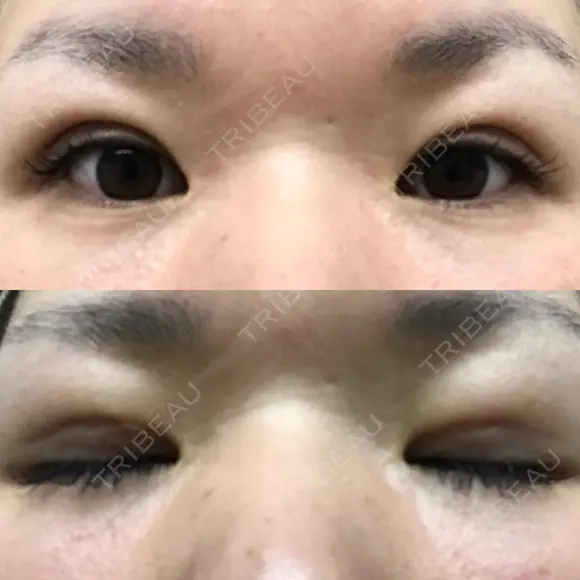 二重埋没 メディカルビューティセンター DAY 8 メイン用