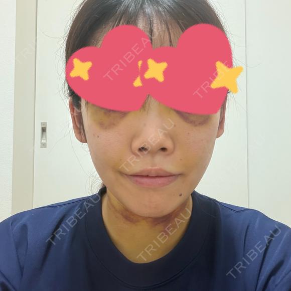 糸リフト / 脂肪吸引（顔） / メーラーファット除去 / 脂肪吸引注射（顔） SEA CLINIC（シークリニック） AFTER メイン用
