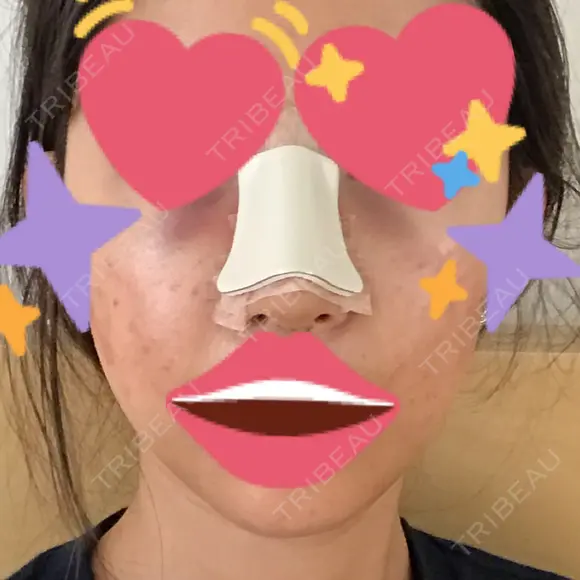 隆鼻術 / 鼻尖形成（切開） / 軟骨移植 / 骨切幅寄せ / ワシ鼻修正・ハンプ切除 / 斜鼻修正 / 鼻修正 韓国BBクリニック（旧 シンミアン形成外科） DAY 1 メイン用