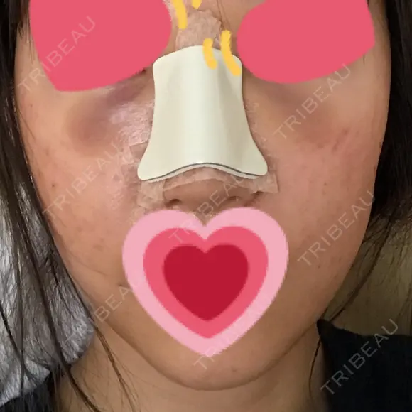 隆鼻術 / 鼻尖形成（切開） / 軟骨移植 / 骨切幅寄せ / ワシ鼻修正・ハンプ切除 / 斜鼻修正 / 鼻修正 韓国BBクリニック（旧 シンミアン形成外科） DAY 2 メイン用