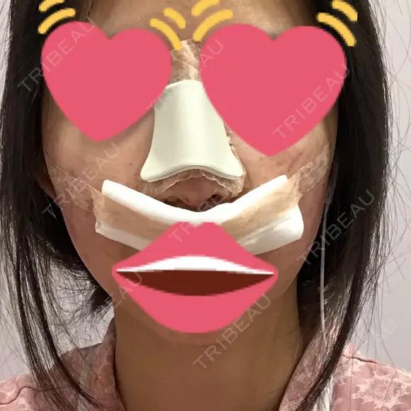 隆鼻術 / 鼻尖形成（切開） / 軟骨移植 / 骨切幅寄せ / ワシ鼻修正・ハンプ切除 / 斜鼻修正 / 鼻修正 韓国BBクリニック（旧 シンミアン形成外科） DAY 0 メイン用