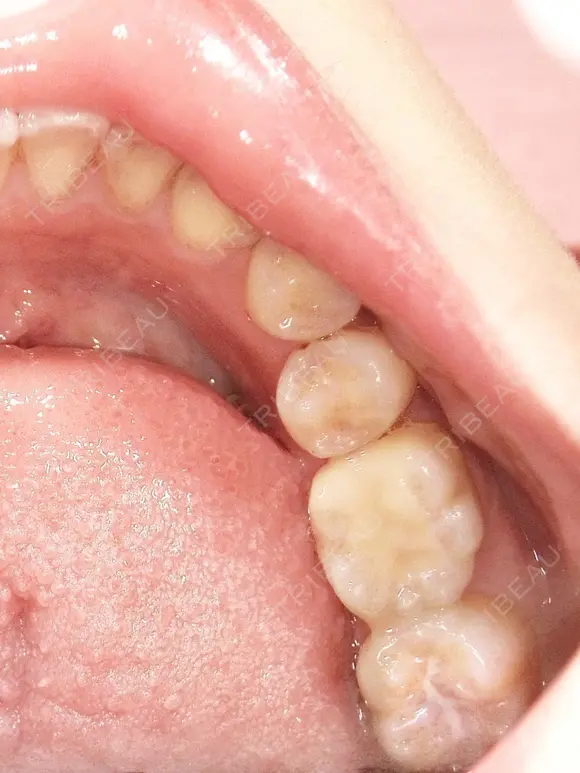 セラミック 東京美容外科 赤坂院 AFTER メイン用