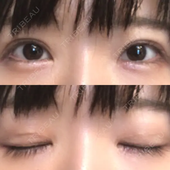 二重切開 / 目元修正 ルネッサンス美容外科医院 神戸院 AFTER メイン用