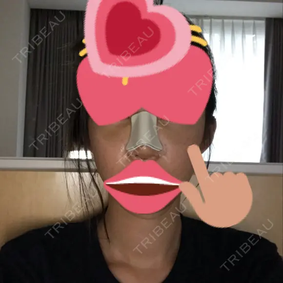 隆鼻術 / 鼻尖形成（切開） / 軟骨移植 / 骨切幅寄せ / ワシ鼻修正・ハンプ切除 / 斜鼻修正 / 鼻修正 韓国BBクリニック（旧 シンミアン形成外科） DAY 3 メイン用