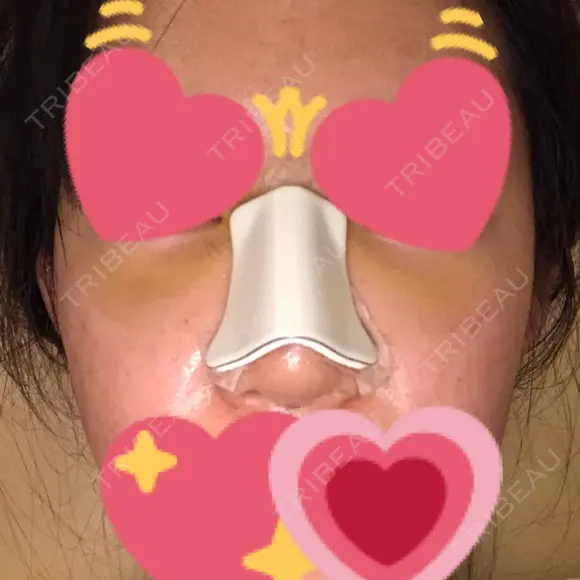 隆鼻術 / 鼻尖形成（切開） / 軟骨移植 / 骨切幅寄せ / ワシ鼻修正・ハンプ切除 / 斜鼻修正 / 鼻修正 韓国BBクリニック（旧 シンミアン形成外科） DAY 4 メイン用