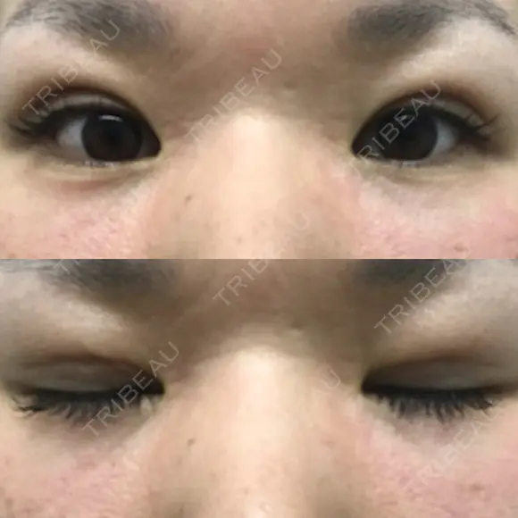 二重埋没 メディカルビューティセンター DAY 11 メイン用