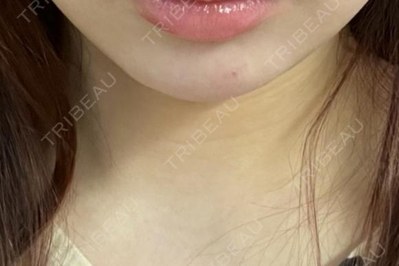 ボトックス（あご） / ヒアルロン酸注入（あご） ルラ美容クリニック 仙台院 / ルラスキンクリニック 仙台院 AFTER メイン用