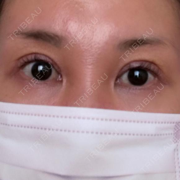 二重切開 / 眼瞼下垂（切開） / 上まぶたたるみ取り 四谷見附クリニック DAY 139 メイン用