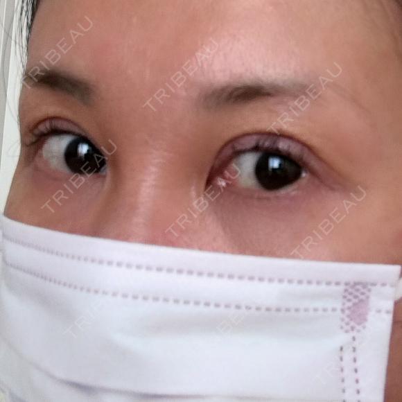 二重切開 / 眼瞼下垂（切開） / 上まぶたたるみ取り 四谷見附クリニック DAY 139 メイン用