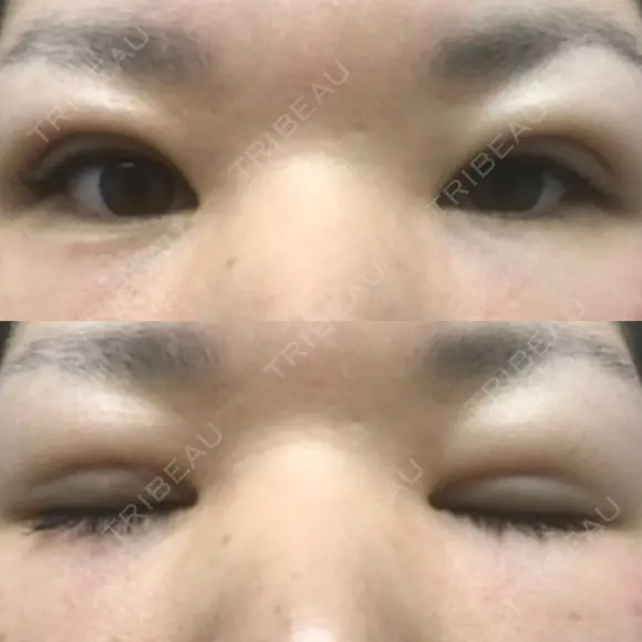 二重埋没 メディカルビューティセンター DAY 13 メイン用