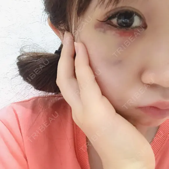 下まぶたの脂肪取り 表参道スキンクリニック 表参道院 DAY 2 メイン用