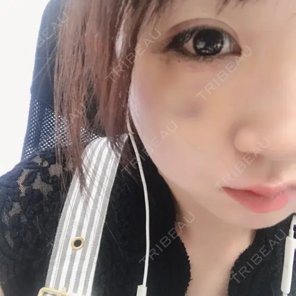 下まぶたの脂肪取り 表参道スキンクリニック 表参道院 DAY 5 メイン用