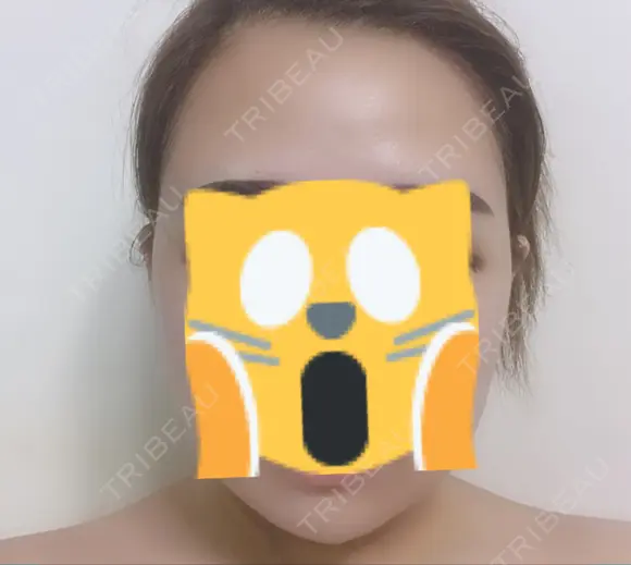 バッカルファット除去 / 脂肪吸引（顔） / ヒアルロン酸注入（あご） / ボトックス（エラ・小顔） エートップ美容整形外科 DAY 3 メイン用