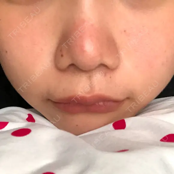 鼻尖形成（切開） / 小鼻縮小（切開） / 軟骨移植 / 眉間プロテーゼ 湘南美容クリニック 熊本院 AFTER メイン用