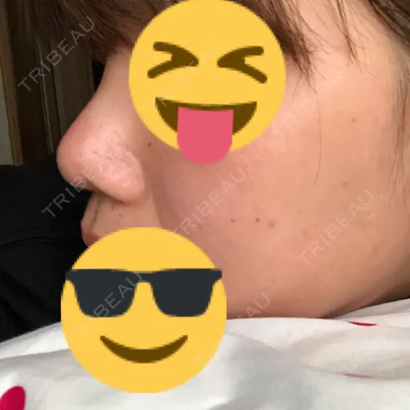 鼻尖形成（切開） / 小鼻縮小（切開） / 軟骨移植 / 眉間プロテーゼ 湘南美容クリニック 熊本院 DAY 79 メイン用