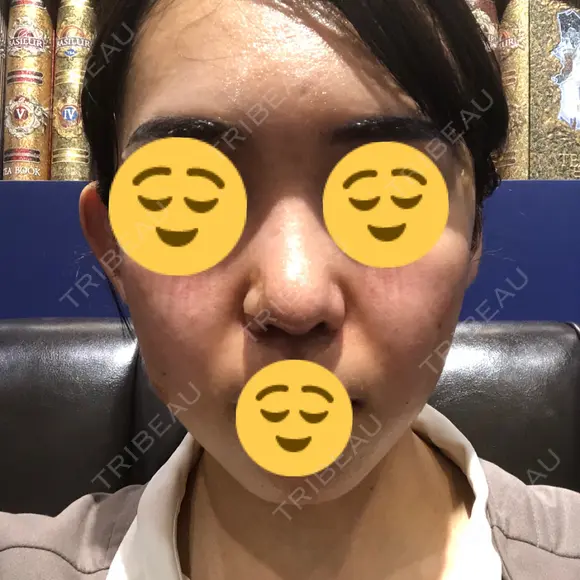 鼻尖形成（切開） / 鼻中隔延長（切開） / 小鼻縮小（切開） / 軟骨移植 / 骨切幅寄せ HANABI整形外科 DAY 128 メイン用