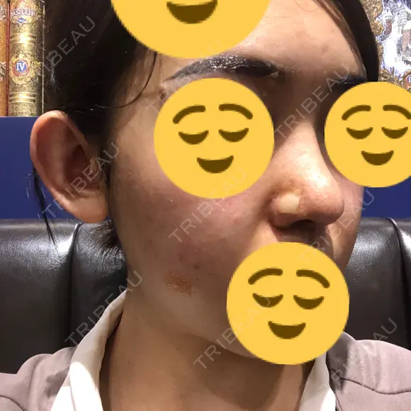 鼻尖形成（切開） / 鼻中隔延長（切開） / 小鼻縮小（切開） / 軟骨移植 / 骨切幅寄せ HANABI整形外科 DAY 128 メイン用