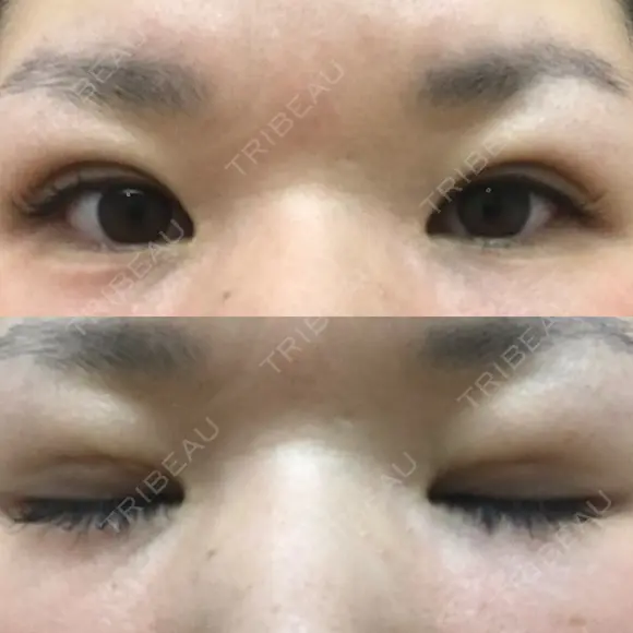 二重埋没 メディカルビューティセンター DAY 14 メイン用