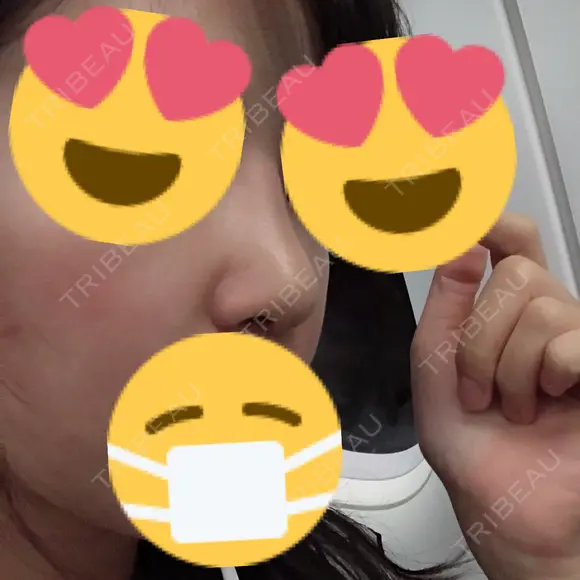 隆鼻術 / 鼻尖形成（切開） / 軟骨移植 / 骨切幅寄せ / ワシ鼻修正・ハンプ切除 / 斜鼻修正 / 鼻修正 韓国BBクリニック（旧 シンミアン形成外科） DAY 8 メイン用