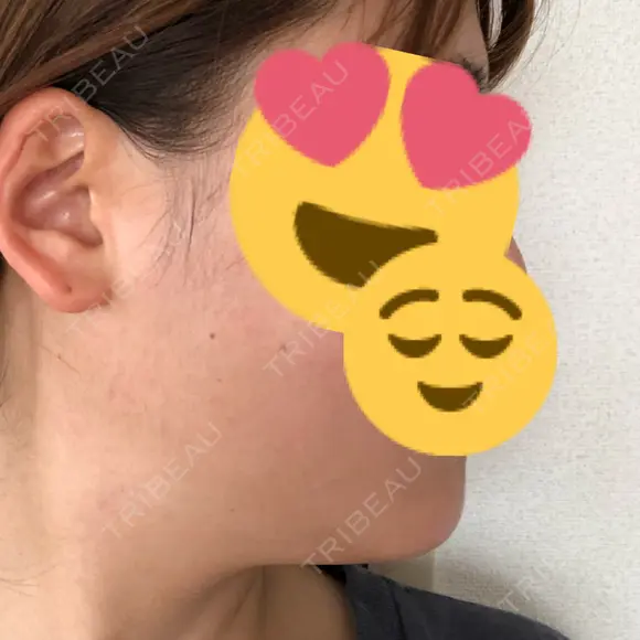 脂肪溶解注射（顔） 聖心美容クリニック 広島院 DAY 19 メイン用