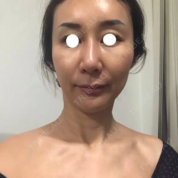 鼻尖形成（切開） / 糸リフト / 目尻切開 / こめかみ形成 / 肌ヒアルロン酸注入（たるみ・シワ改善） / ヒアルロン酸注入（あご） / ヒアルロン酸注入（唇） あきこクリニック DAY 15 メイン用