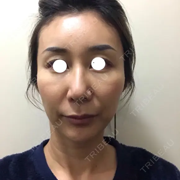 鼻尖形成（切開） / 糸リフト / 目尻切開 / こめかみ形成 / 肌ヒアルロン酸注入（たるみ・シワ改善） / ヒアルロン酸注入（あご） / ヒアルロン酸注入（唇） あきこクリニック DAY 19 メイン用