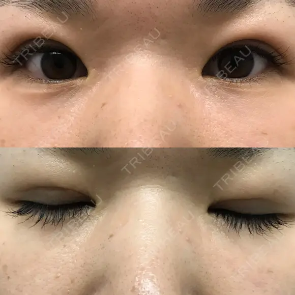 二重埋没 メディカルビューティセンター DAY 18 メイン用