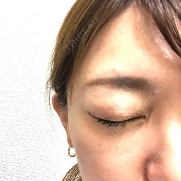 クマ治療 / 下まぶたの脂肪取り TCB東京中央美容外科 中野院 DAY 9 メイン用