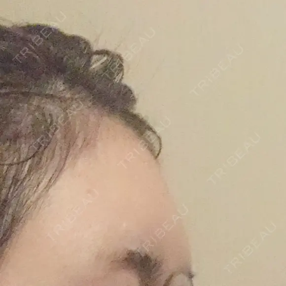 額を丸く / ヒアルロン酸注入（額） エートップ美容整形外科 DAY 4 メイン用