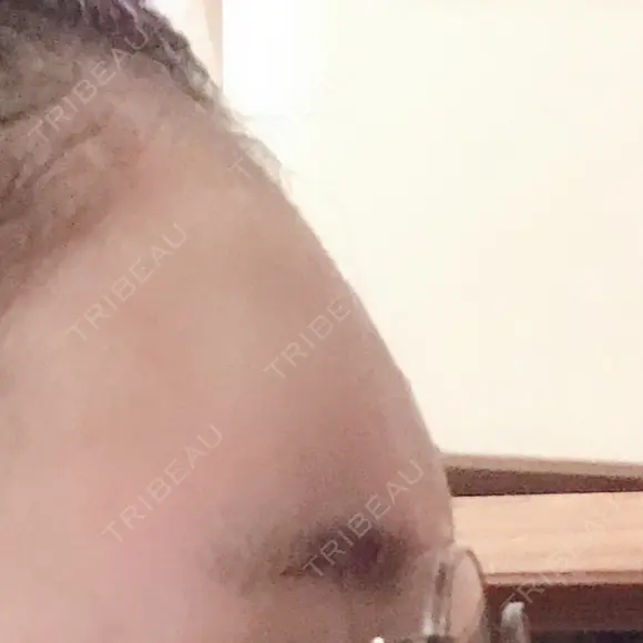 額を丸く / ヒアルロン酸注入（額） エートップ美容整形外科 DAY 5 メイン用