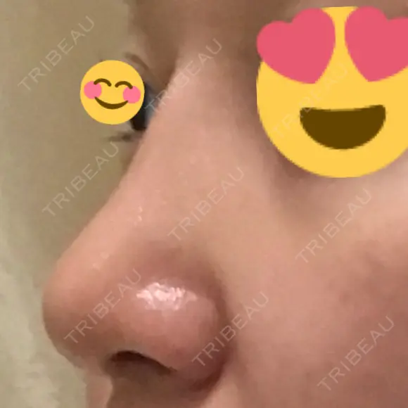 隆鼻術 / 鼻尖形成（切開） / 軟骨移植 / 骨切幅寄せ / ワシ鼻修正・ハンプ切除 / 斜鼻修正 / 鼻修正 韓国BBクリニック（旧 シンミアン形成外科） AFTER メイン用