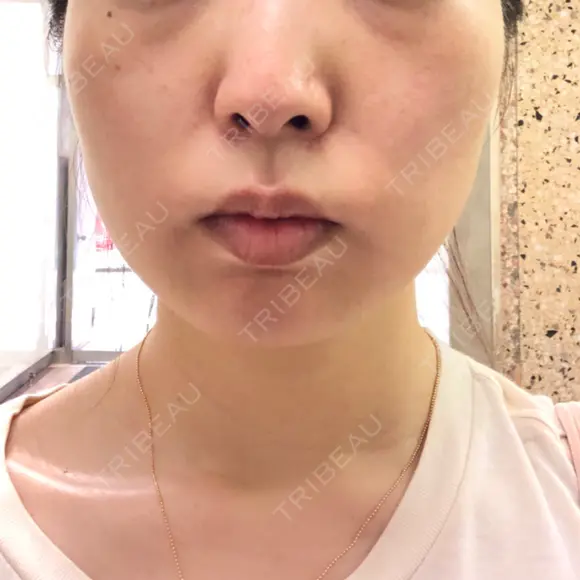 脂肪溶解注射（顔） ビクアスクリニック DAY 19 メイン用