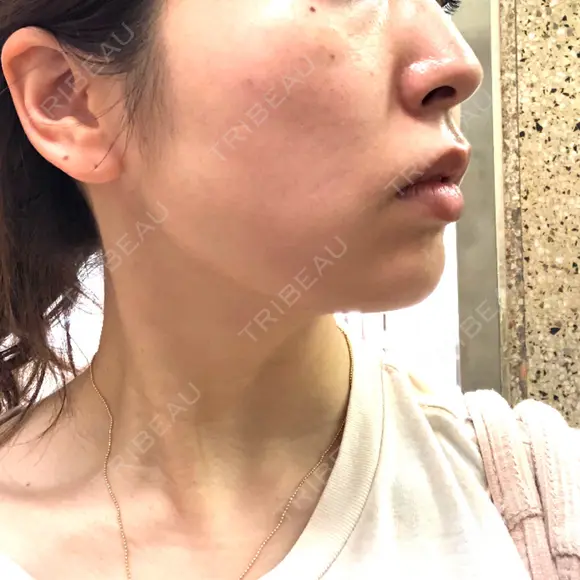 脂肪溶解注射（顔） ビクアスクリニック DAY 19 メイン用