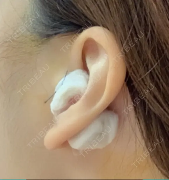 鼻尖形成（切開） / 鼻中隔延長（切開） / 軟骨移植 / 骨切幅寄せ / ワシ鼻修正・ハンプ切除 / 眉間プロテーゼ グロービー美容整形外科 DAY 0 メイン用