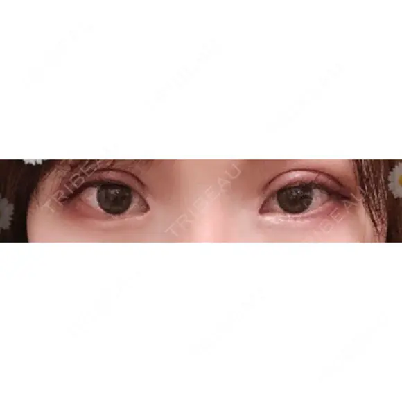 二重切開 / 目頭切開 / 上まぶたの脂肪取り / 蒙古ひだ形成 FROM B整形外科 (旧バウム整形外科) DAY 25 メイン用